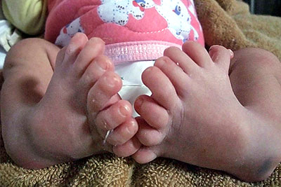 В Китае родился младенец с восемью пальцами на каждой ноге