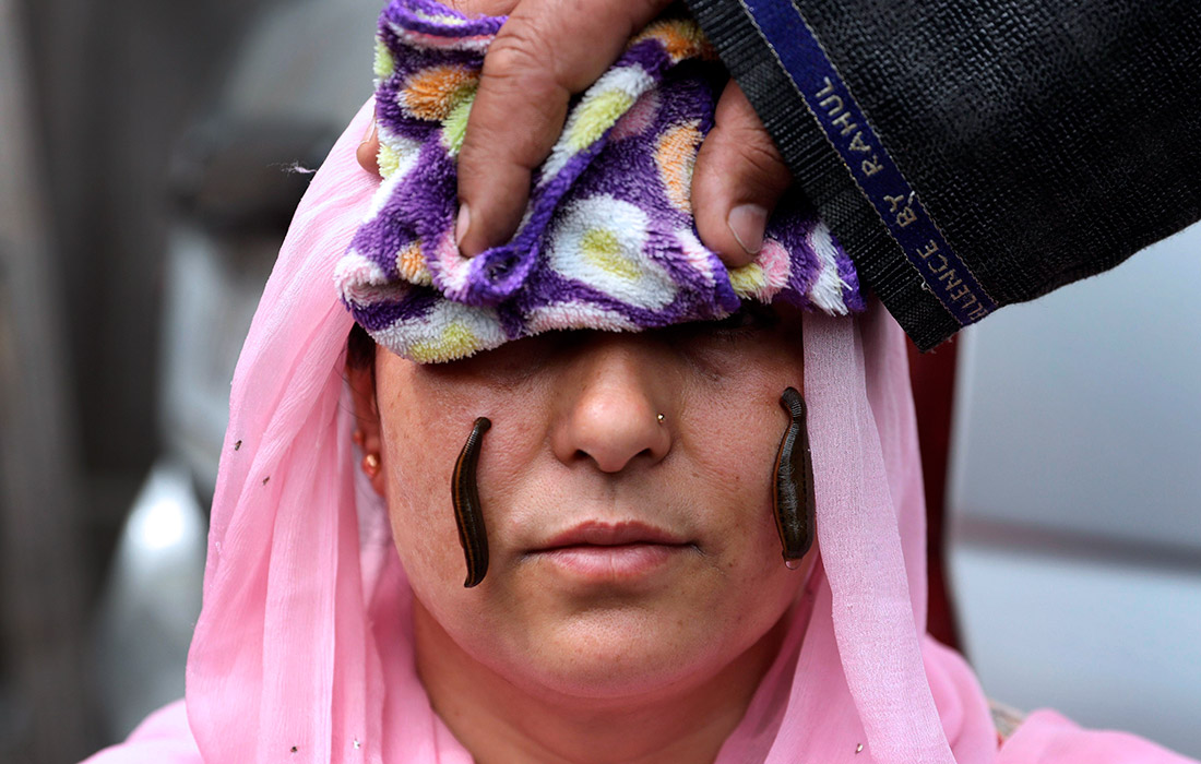 Во время сеанса лечения пиявками на обочине дороги в Сринагаре, Индия