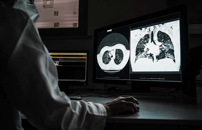 Проценко заявил, что "омикрон" поражает меньше легочной ткани, чем другие штаммы